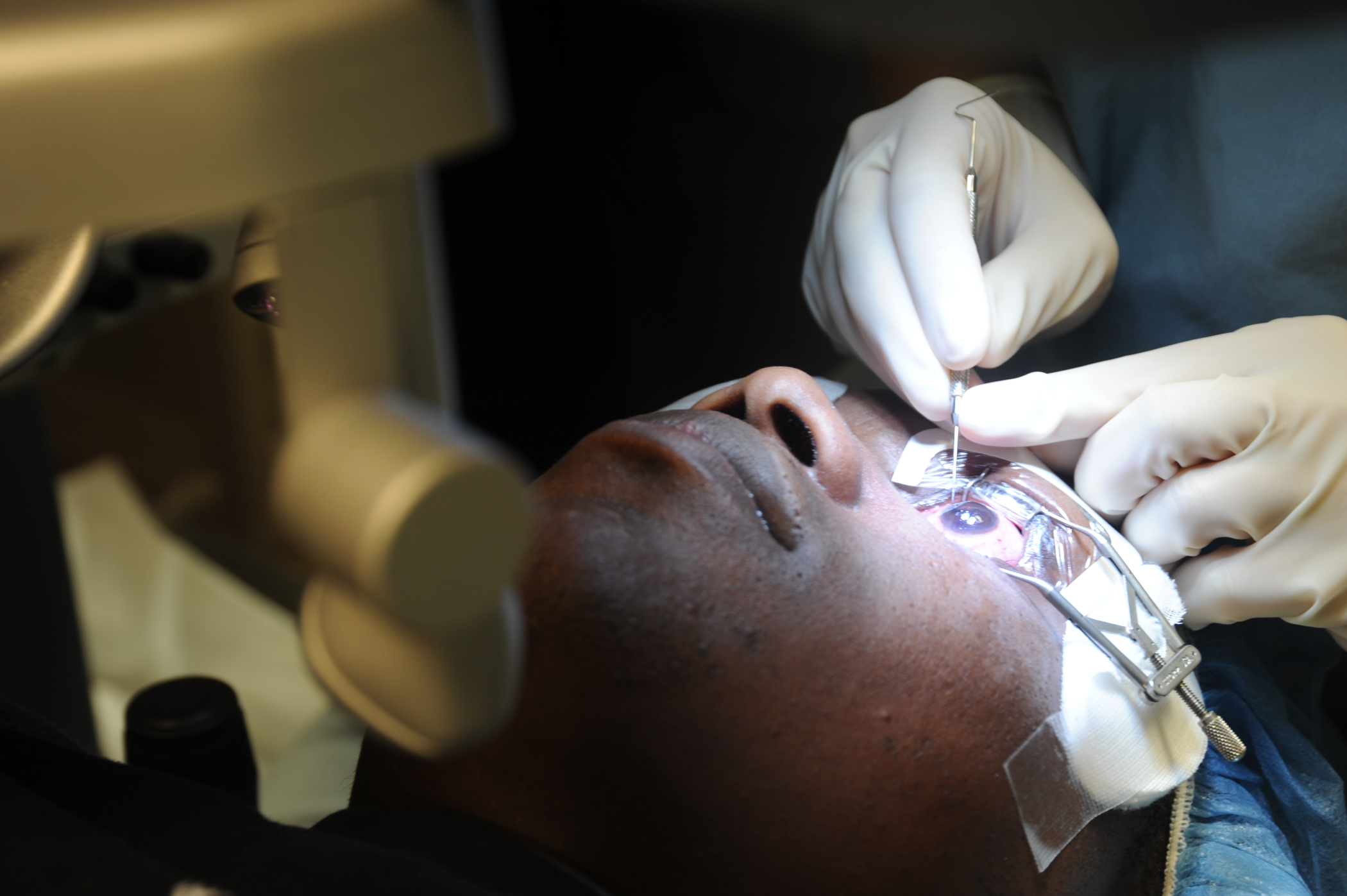 Refractive Surgery