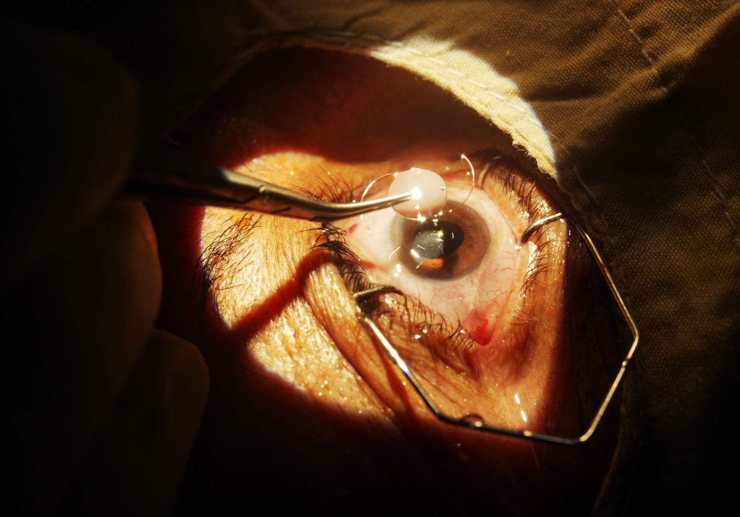 Cataract Surgery