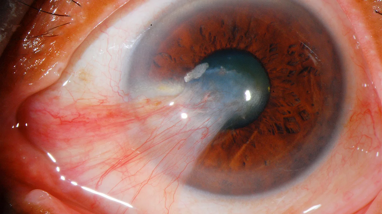 Pterygium Treatment